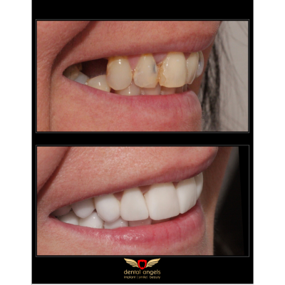 Before - After