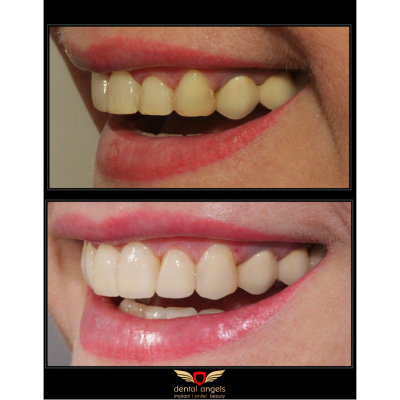 Before - After
