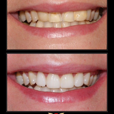 Before - After