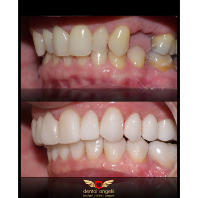 Before - After