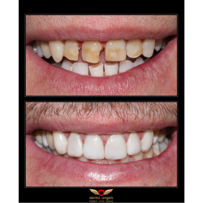 Before - After