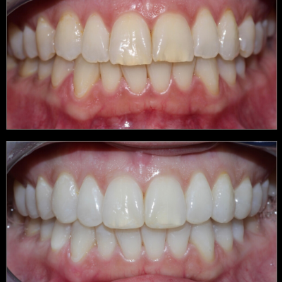Before - After