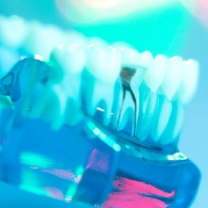 La dévitalisation de la dent